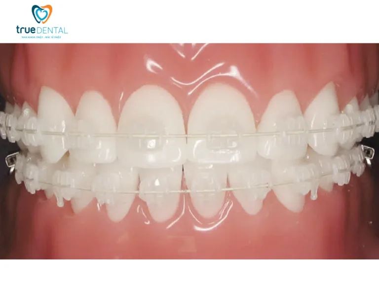 Niềng răng mắc cài ceramic so với mắc cài kim loại và khay trong suốt