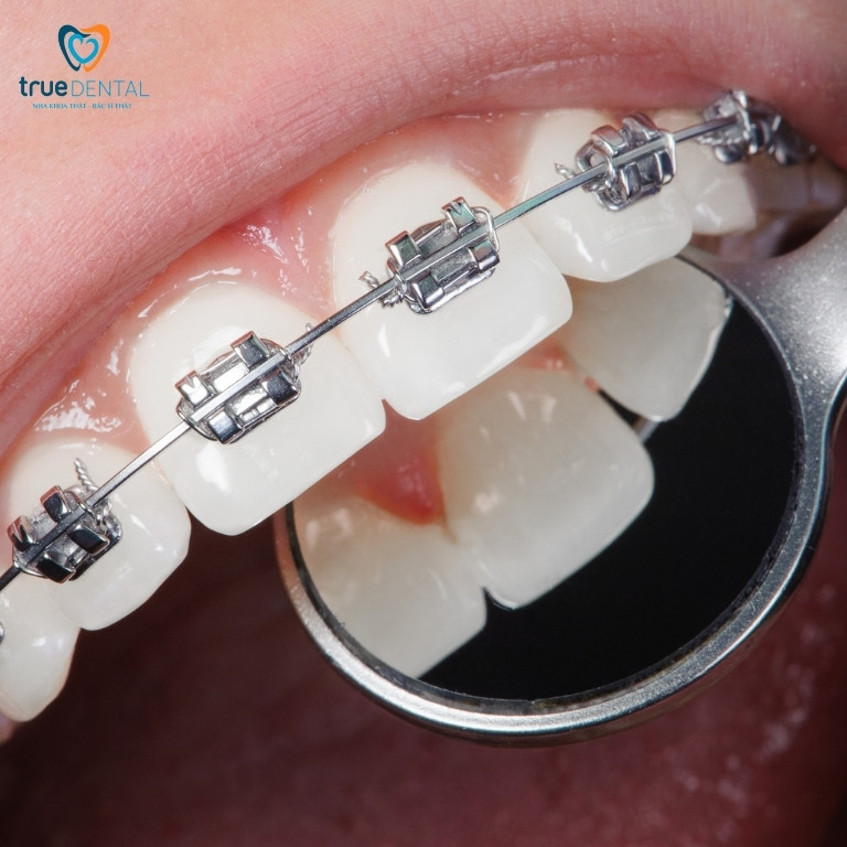 Quy trình đánh giá tiền điều trị niềng răng cho người bị cao huyết áp
