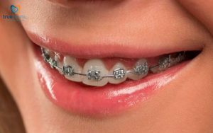 Rủi ro dị ứng với mắc cài niềng