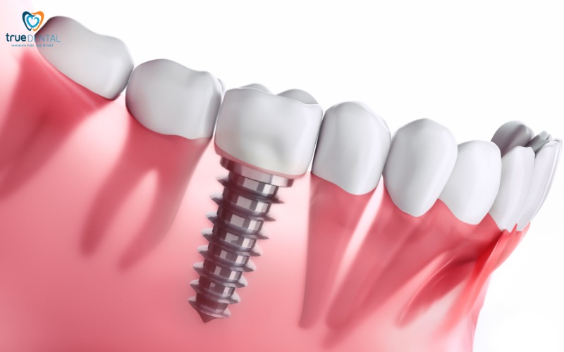 Rủi ro trụ implant bị gãy xảy ra phổ biến như thế nào