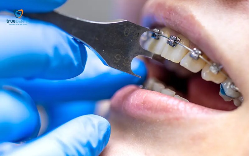 Tại sao giai đoạn theo dõi sau niềng răng quan trọng không kém giai đoạn đeo mắc cài