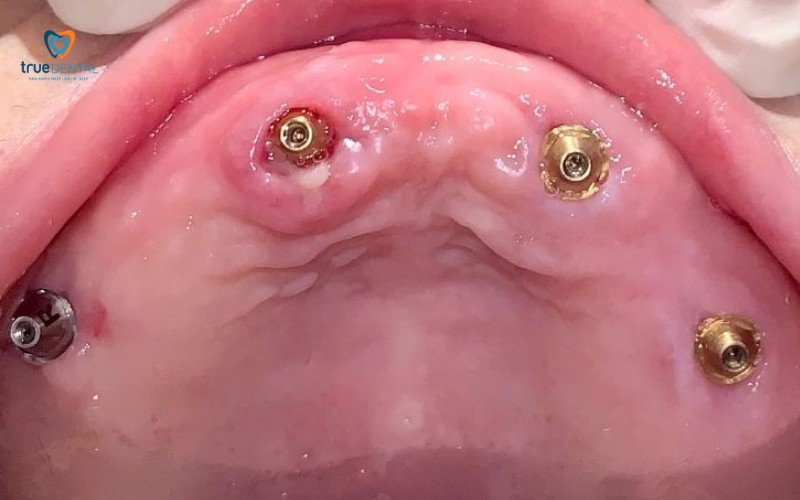 Tại sao vùng cấy ghép implant bị đau và sưng sau phẫu thuật