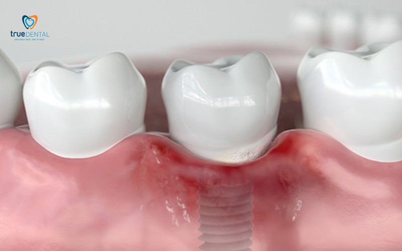 implant tức thì