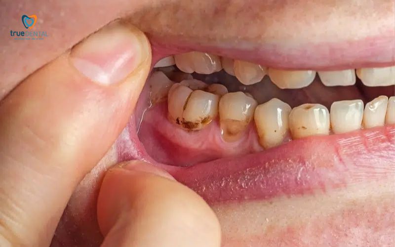 Cạo vôi răng bằng tay là gì - Giải đáp chi tiết từ chuyên gia True Dental 11 Cạo vôi răng bằng tay khác gì so với cạo vôi bằng máy siêu âm