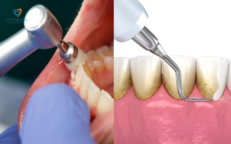 Cạo vôi răng bằng tay là gì - Giải đáp chi tiết từ chuyên gia True Dental 10 Cạo vôi răng bằng tay là gì và nguồn gốc của phương pháp này