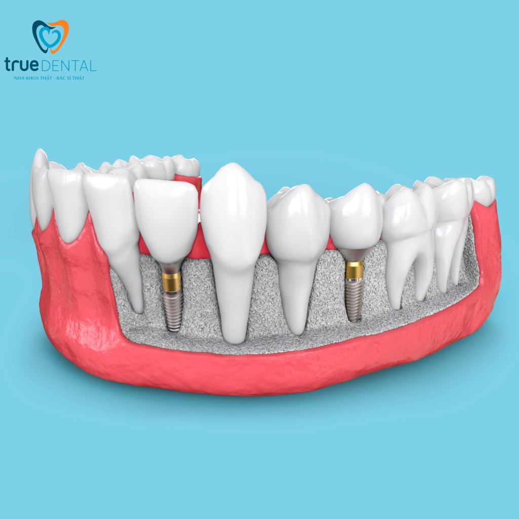 Câu hỏi thường gặp về trụ implant Megagen