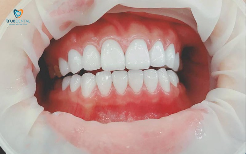 Khả năng ăn nhai sau bọc sứ được cải thiện toàn diện