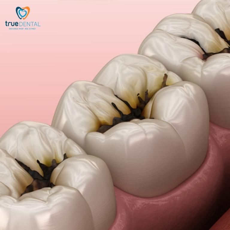 Những vị trí trên răng dễ bị sâu nhất khi đang niềng răng