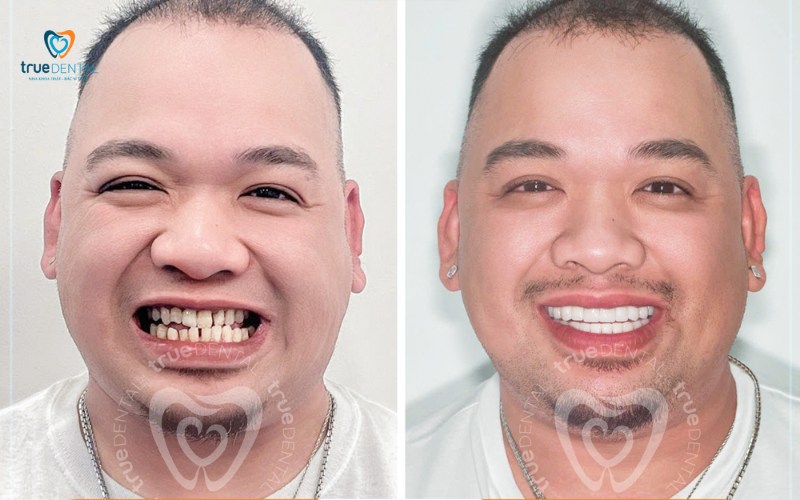 Những yếu tố giúp kéo dài tuổi thọ mão sứ hiệu quả nhất