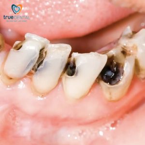 Rủi ro sâu răng ở người nghiện cà phê