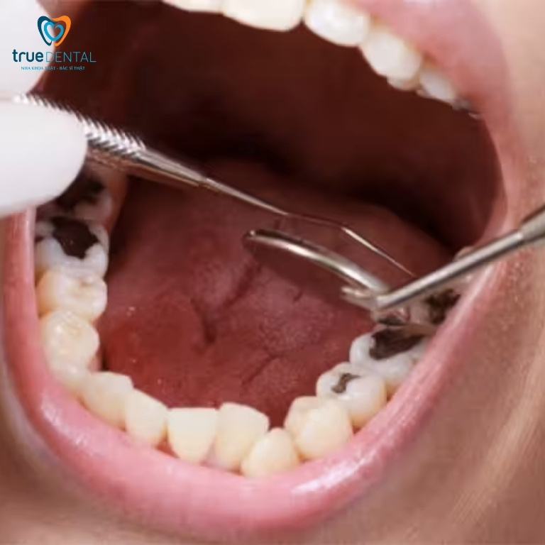 Sâu răng do uống cà phê tiến triển theo những giai đoạn nào