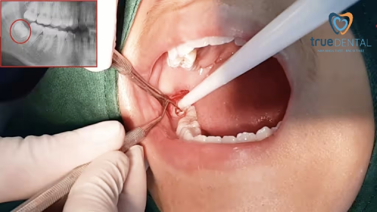 Theo dõi xương hàm sau nhổ và quyết định thời điểm phục hình