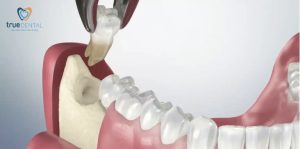 Thời gian theo dõi sau nhổ răng