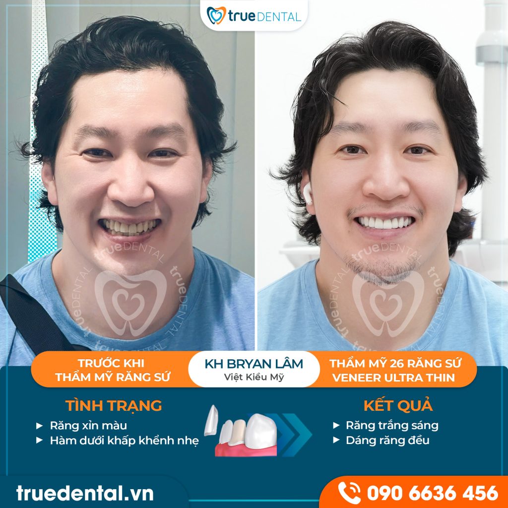 Hình ảnh sứ thẩm mỹ trước sau True Dental phản ánh điều gì