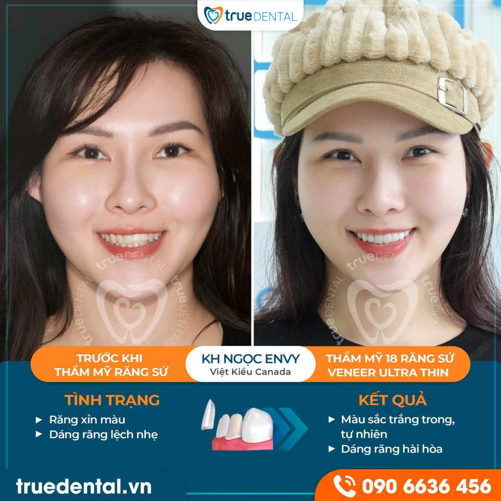 Hình ảnh sứ thẩm mỹ trước sau tại True Dental