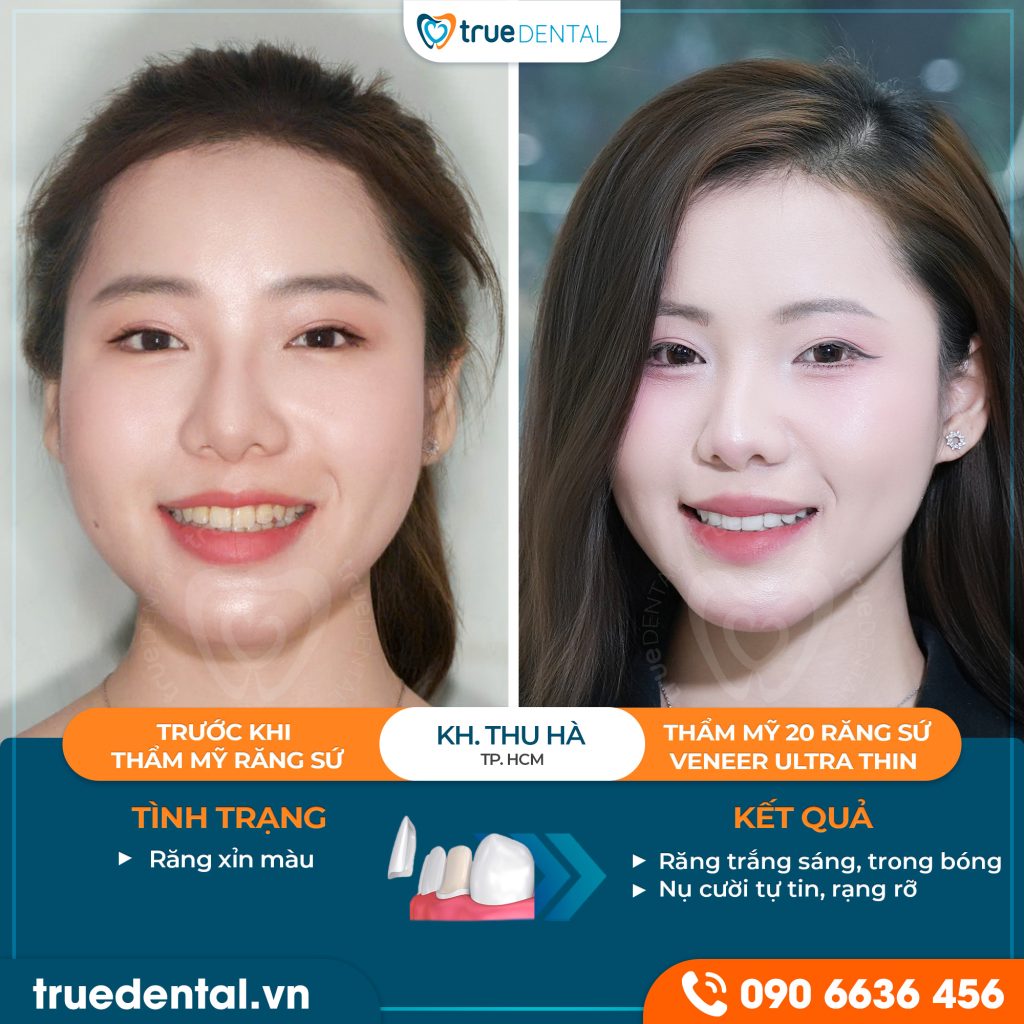 Cơ chế tạo ra sự thay đổi trong ảnh sứ thẩm mỹ trước và sau