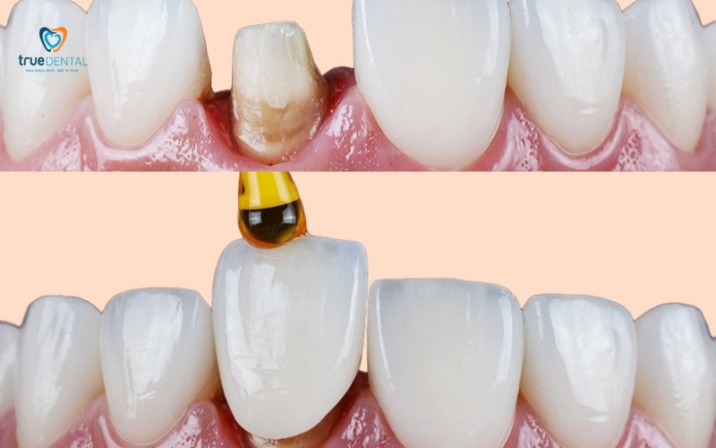 Bọc sứ thẩm mỹ bao gồm những gì trong gói theo từng giai đoạn