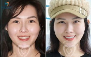 Bọc sứ thẩm mỹ khách hàng True Dental hài lòng không