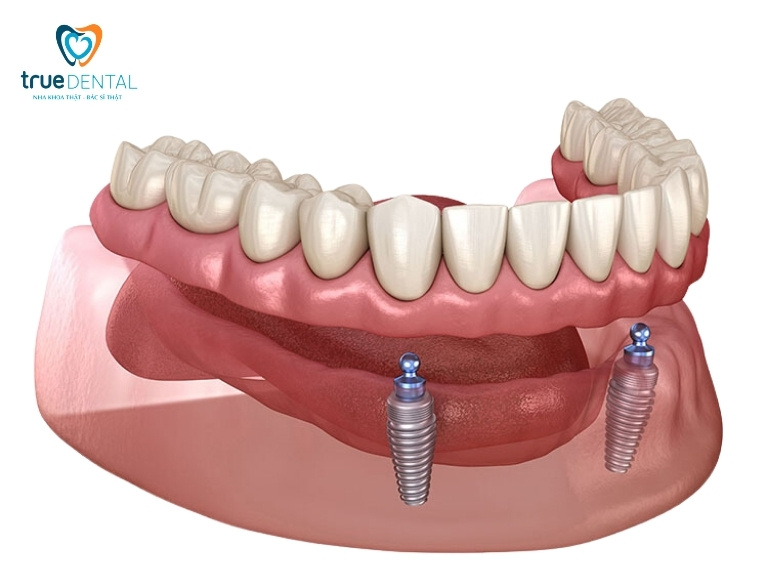 Implant tại True Dental có dùng trụ chính hãng không - Câu trả lời từ nha sĩ 2026 3 Câu hỏi thường gặp về implant tại True Dental có dùng trụ chính hãng không