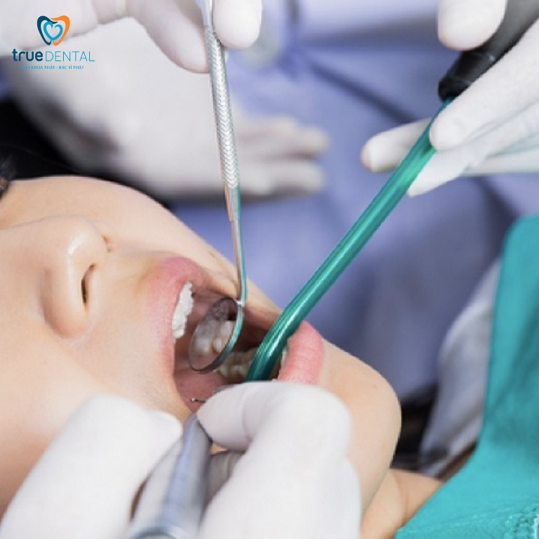 Câu hỏi thường gặp về nhổ răng khôn tại TPHCM