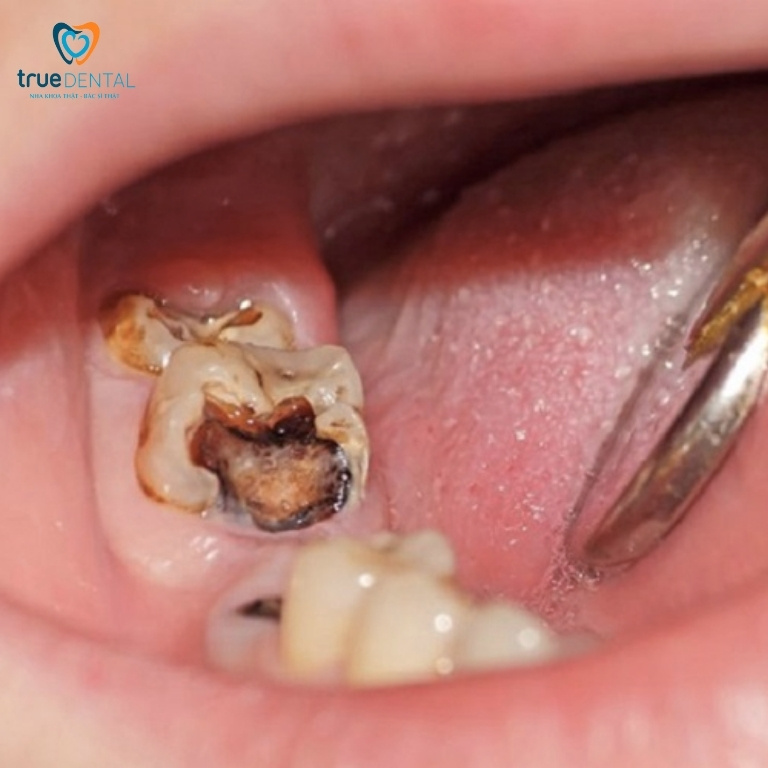 Nhổ răng không đau tại TPHCM – Quy trình an toàn và giá tham khảo tại Nha khoa True Dental 4 Câu hỏi thường gặp về nhổ răng không đau tại TPHCM