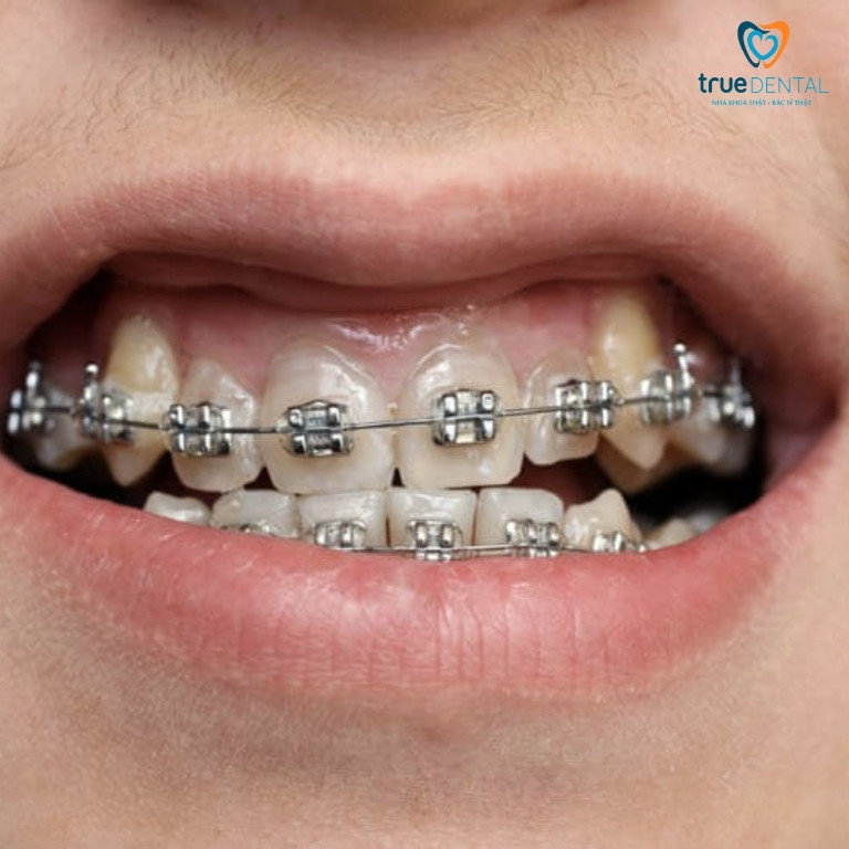Câu hỏi thường gặp về niềng răng hai hàm giá bao nhiêu TPHCM
