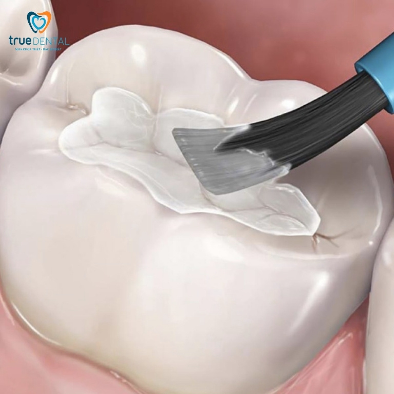 Câu hỏi thường gặp về trám răng tại Quận 3