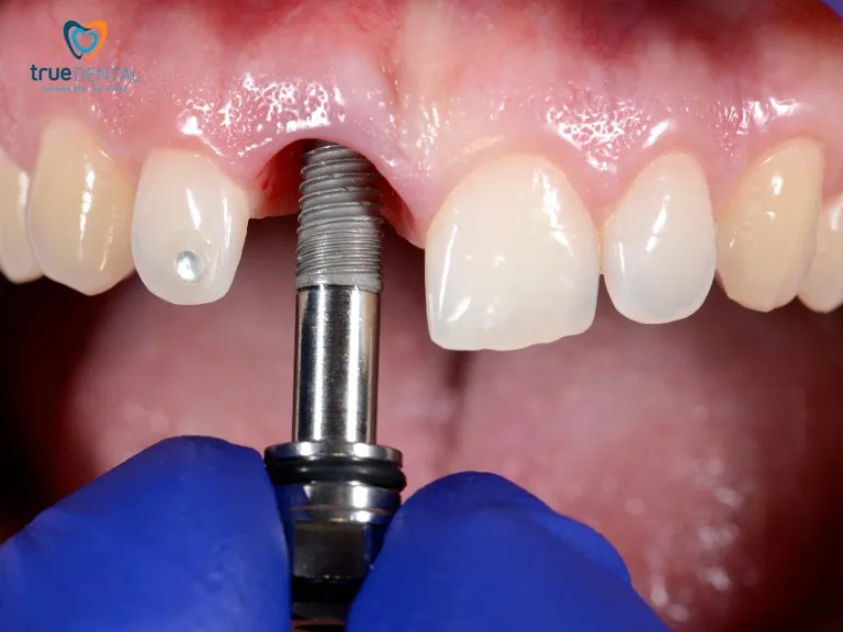 Implant 4 răng cửa hoạt động như thế nào