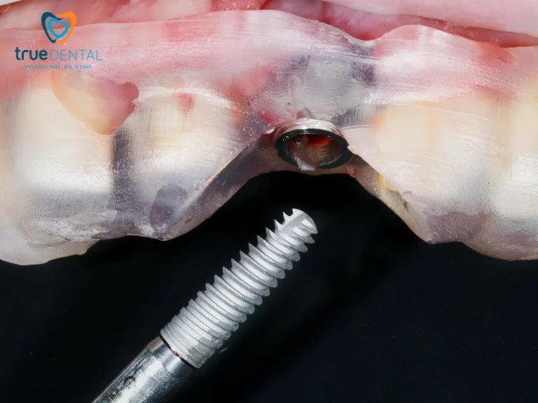 Lời khuyên từ bác sĩ khi chọn implant 4 răng cửa