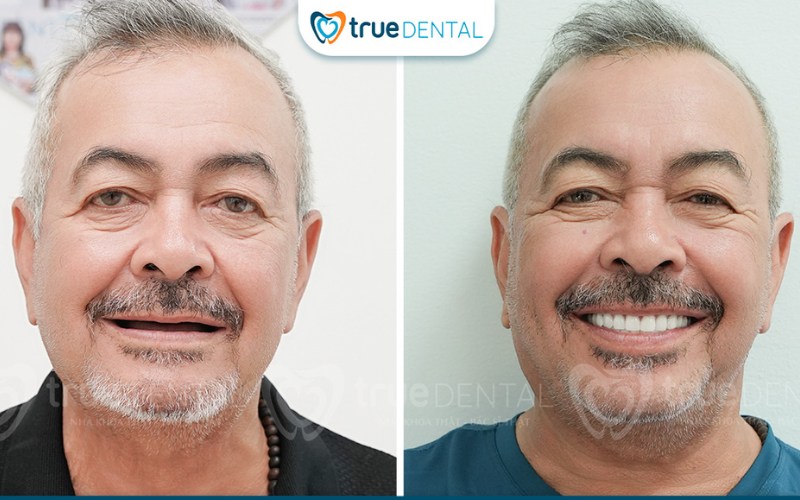 Minh bạch chi phí implant trước điều trị bằng văn bản