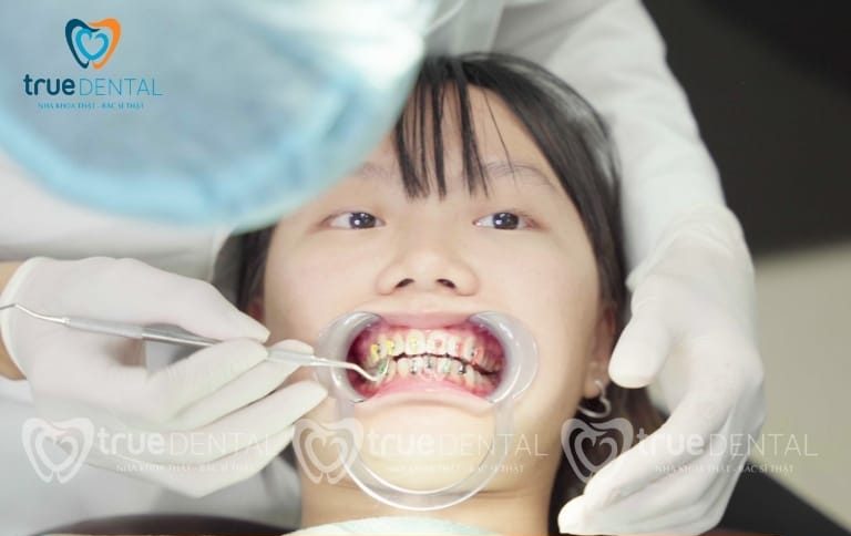 Niềng răng Quận 3 TPHCM giá rẻ có thực sự an toàn không