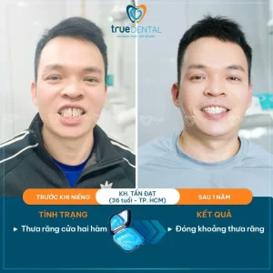 Niềng răng Transalign có an toàn không