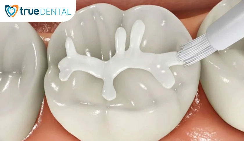 Quy trình trám răng thẩm mỹ tại True Dental diễn ra như thế nào
