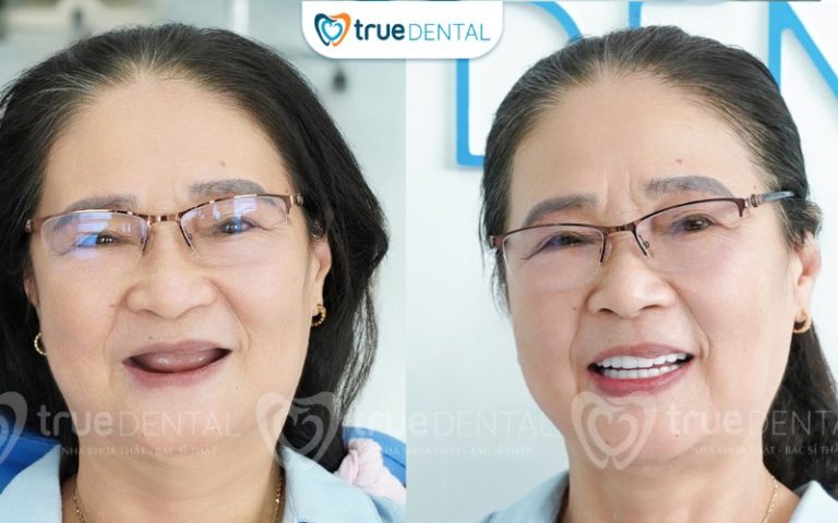 True Dental cam kết implant chính hãng không