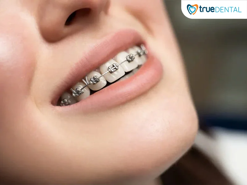 Tư vấn niềng răng miễn phí Quận 3 giúp gì cho bạn