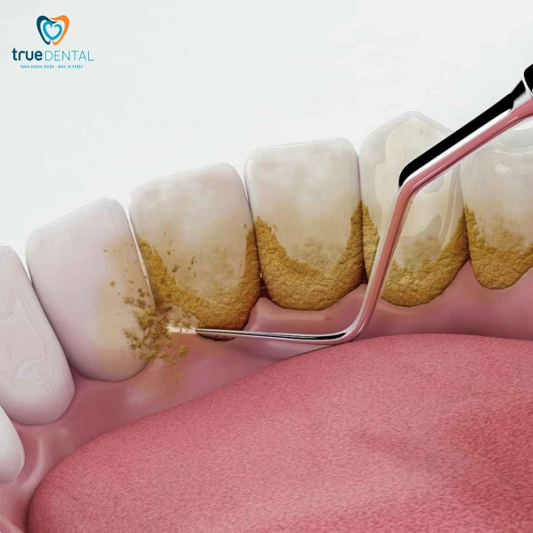 cạo vôi răng có cần thiết không và nên làm bao lâu một lần
