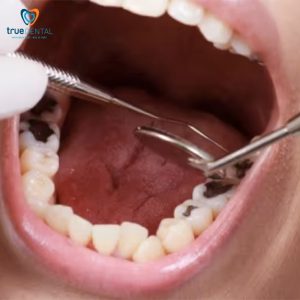 nhổ răng không đau tại TPHCM