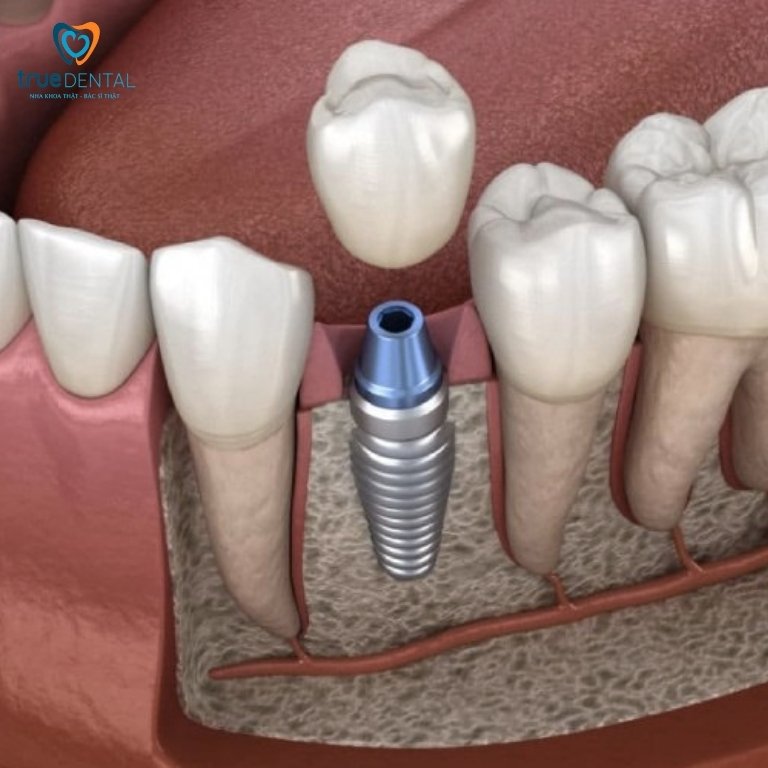 niềng răng sau khi trồng implant được không