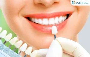 sứ thẩm mỹ True Dental bảo hành bao lâu