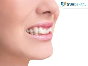 tư vấn niềng răng miễn phí Quận 3