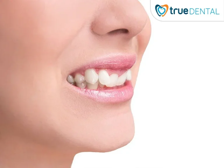 tư vấn niềng răng miễn phí Quận 3
