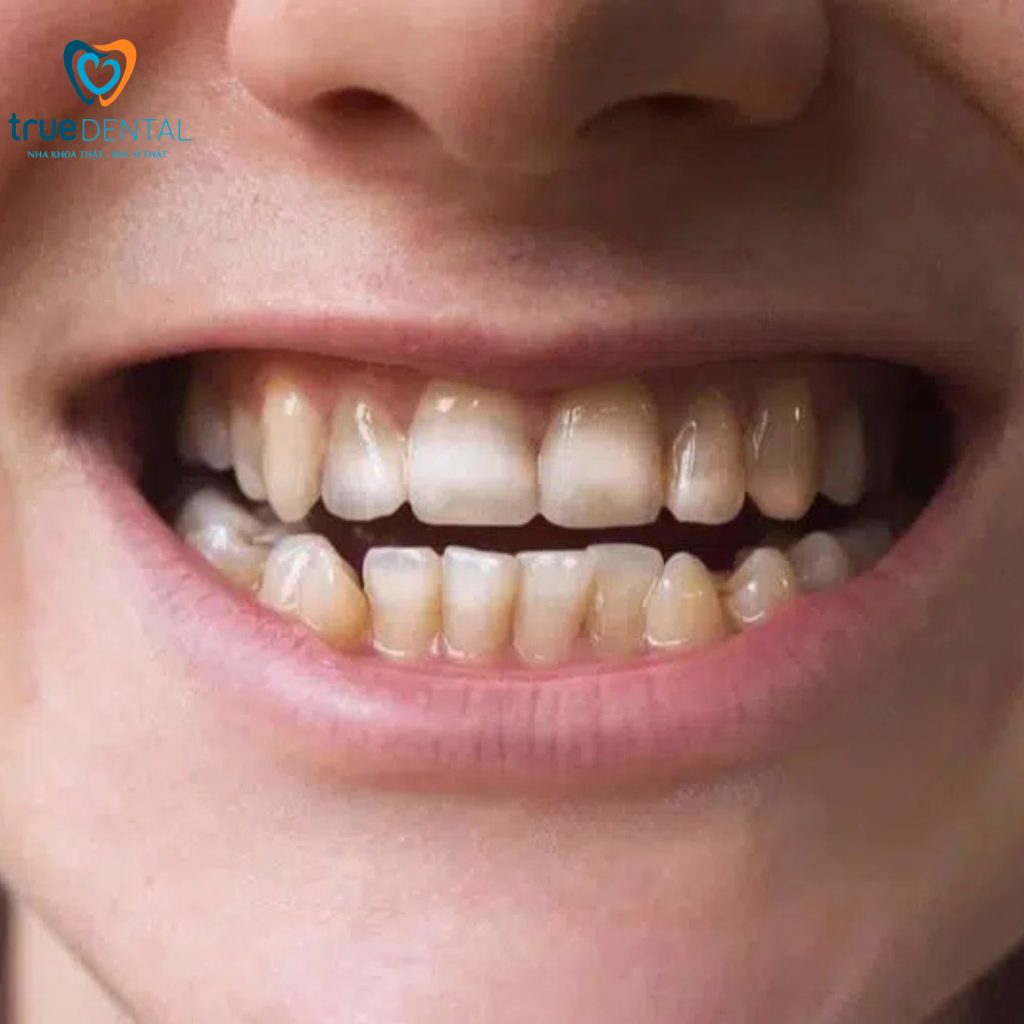 Bác sĩ Đỗ Thái Vĩnh Lai giải đáp fluor có tốt cho răng trẻ em không