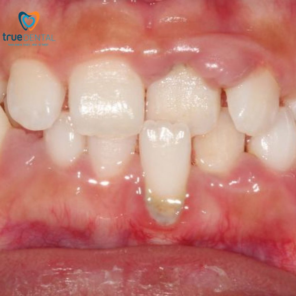 Bác sĩ Đỗ Thái Vĩnh Lai giải đáp tụt lợi điều trị bằng cách nào