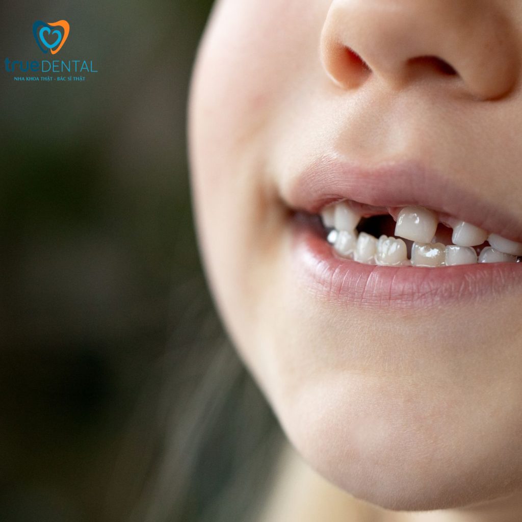 Bác sĩ Đỗ Thái Vĩnh Lai trả lời thẳng về sún răng ở trẻ nhỏ có nguy hiểm không