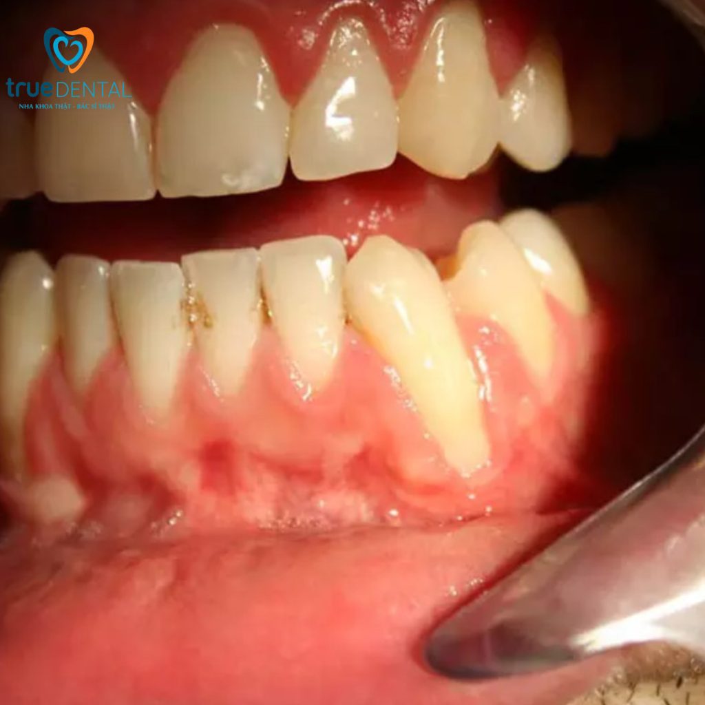Bằng chứng khoa học về tụt lợi điều trị bằng cách nào hiệu quả nhất