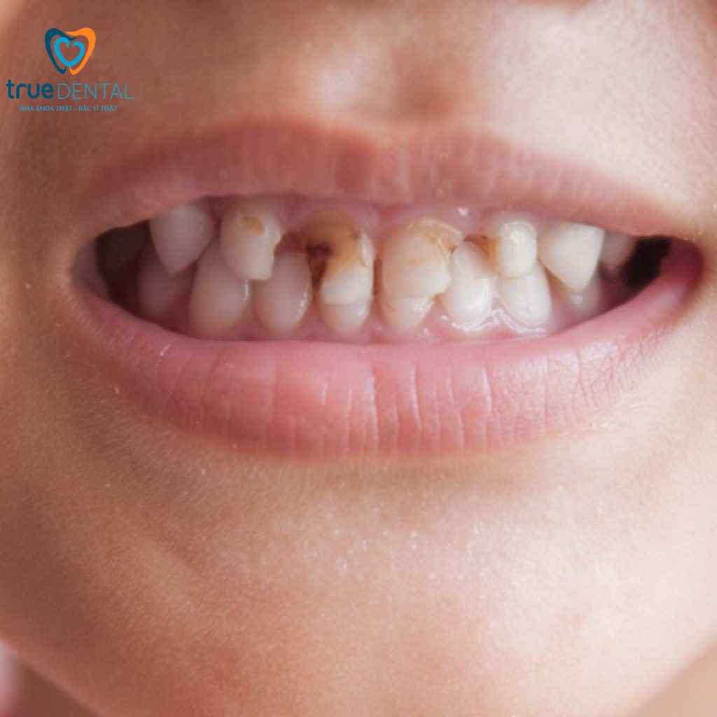 Nghiên cứu quốc tế nói gì về sún răng ở trẻ nhỏ có nguy hiểm không