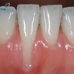Tụt lợi điều trị bằng cách nào