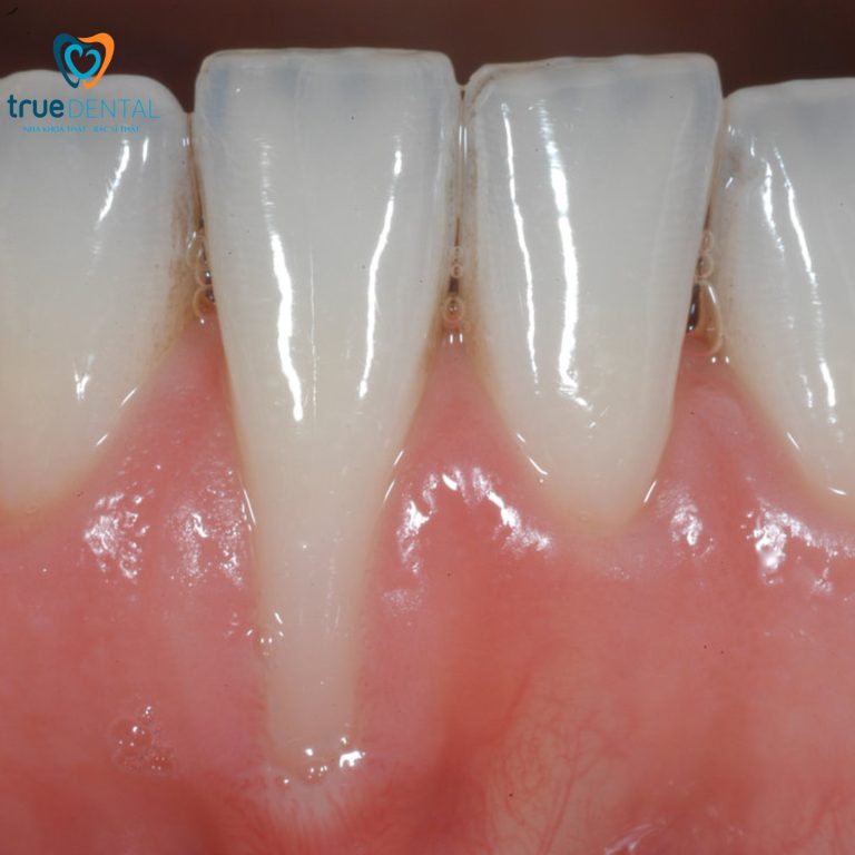 Tụt lợi điều trị bằng cách nào