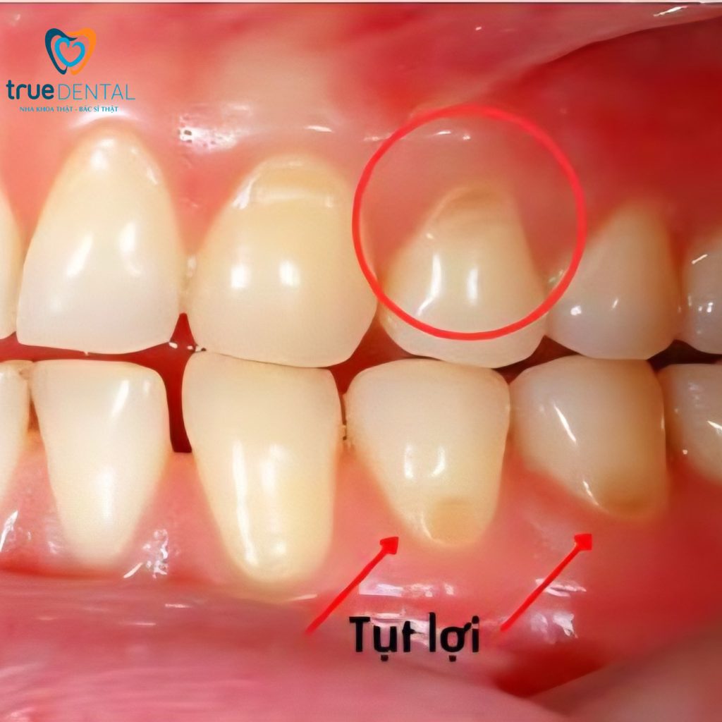 Tụt lợi điều trị bằng cách nào nếu đã ê buốt rất nặng