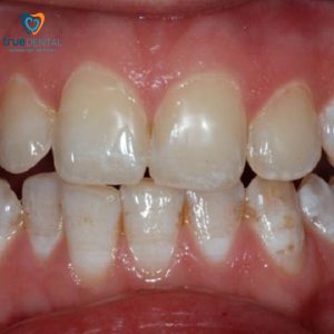 fluor có tốt cho răng trẻ em không
